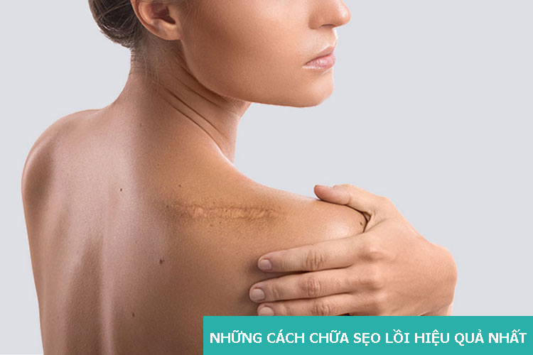 Tổng hợp những cách chữa sẹo lồi hiệu quả nhất 1