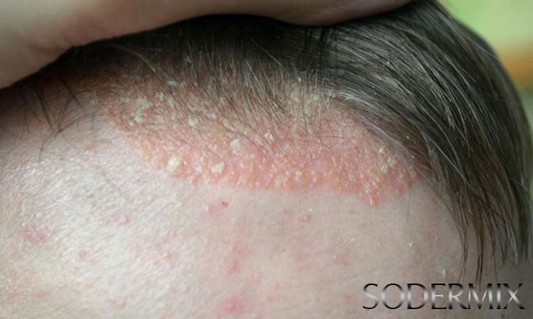 Dấu hiệu bệnh chàm da đầu 2