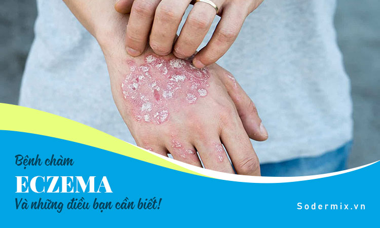 Bệnh chàm eczema và những điều bạn cần biết!