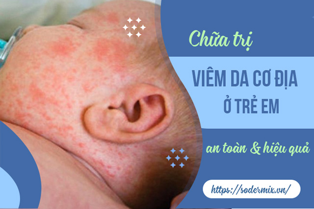 Trị viêm da cơ địa ở trẻ an toàn mà hiệu quả bằng cách nào?