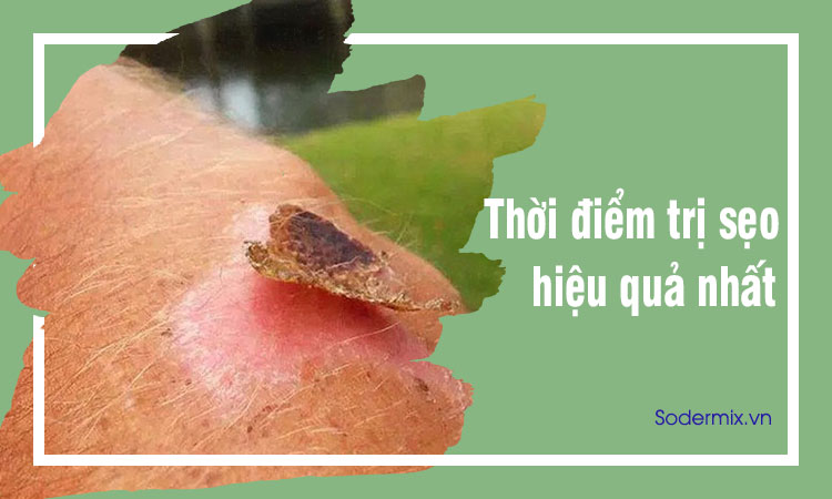 Khi nào là thời điểm trị sẹo hiệu quả nhất 1