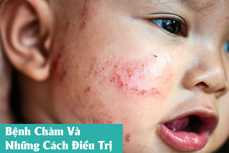 Tổng hợp cách điều trị bệnh chàm triệt để 1