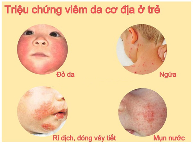 Dấu hiệu nhận biết viêm da cơ địa ở trẻ 1