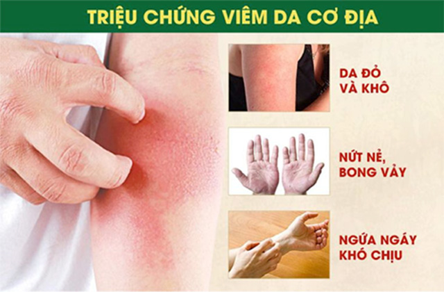 Triệu chứng của viêm da cơ địa 1