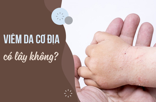 Bệnh viêm da cơ địa có lây không? 1