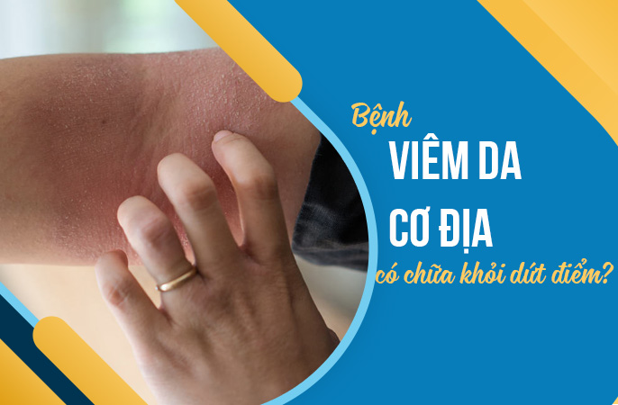 Bị viêm da cơ địa có chữa khỏi dứt điểm được không? 1