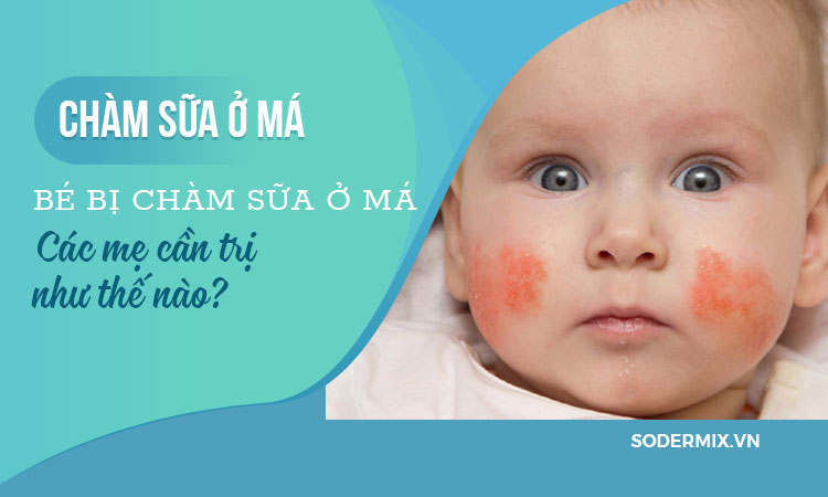 Bé bị chàm sữa ở má, trị như thế nào?