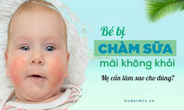 Bé bị chàm sữa mãi không khỏi, mẹ phải làm sao?