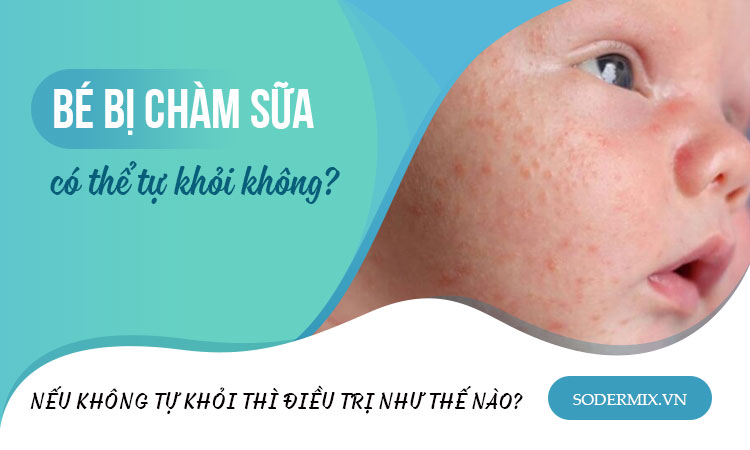 Bé bị chàm sữa có thể tự khỏi không?