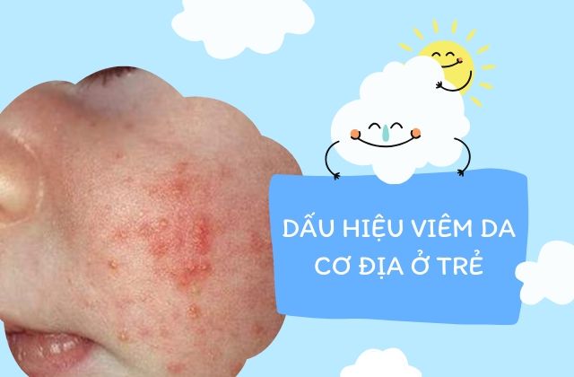 Dấu hiệu viêm da cơ địa ở trẻ em 1