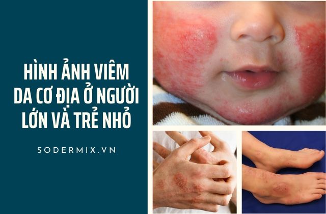 Hình ảnh viêm da cơ địa ở trẻ em và người lớn 1