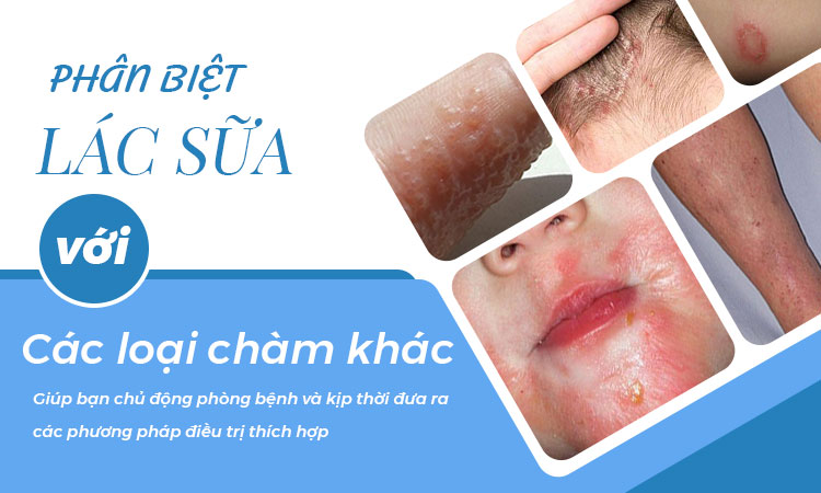 Cách phân biệt lác sữa với các loại bệnh chàm khác 1