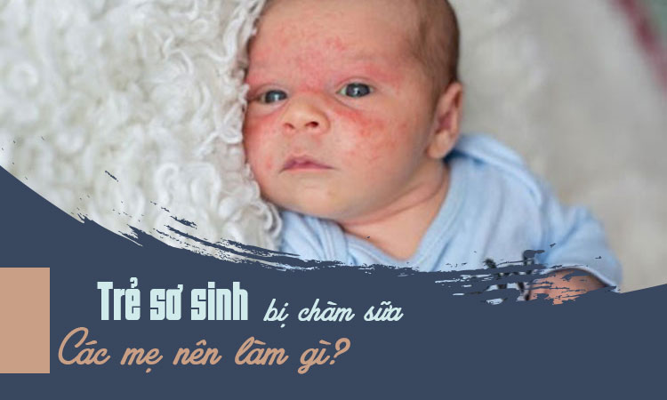 Chàm sữa (lác sữa) ở trẻ - điều mẹ phải biết! 1