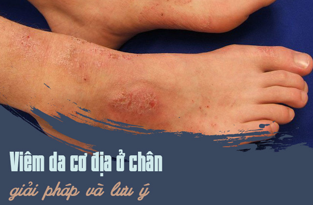 Trị viêm da cơ địa ở chân giải pháp và những lưu ý 1