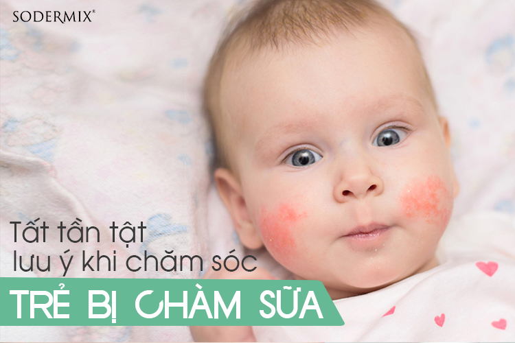 Hướng dẫn mẹ chăm sóc trẻ bị chàm sữa đúng cách!