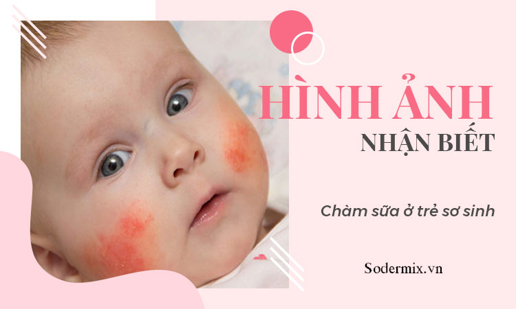 Hình ảnh nhận biết chàm sữa ở trẻ sơ sinh 1