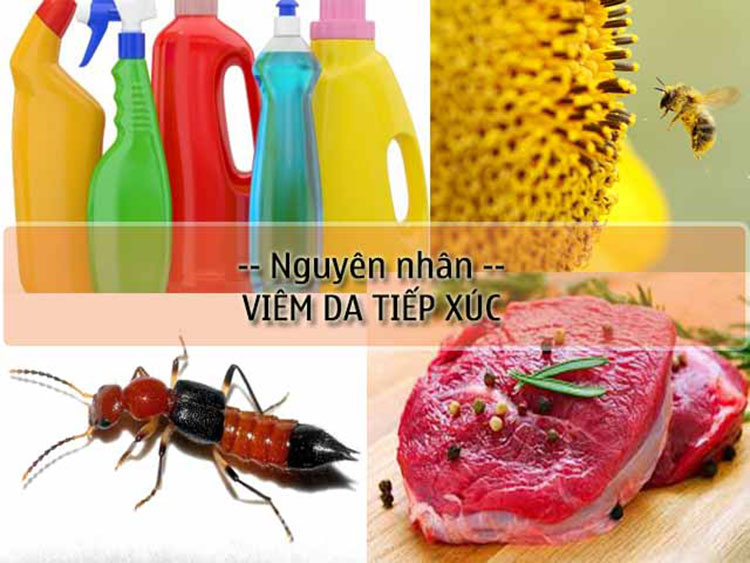 Tiếp xúc với các hóa chất tẩy rửa, dị ứng với thực phẩm, côn trùng cắn, phấn hoa,…là nguyên nhân gây viêm da tiếp xúc.