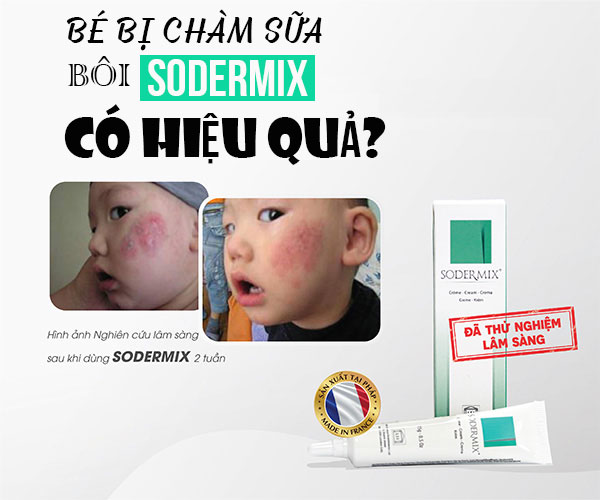 Bé bị chàm sữa bôi sodermix có hiệu quả không ?