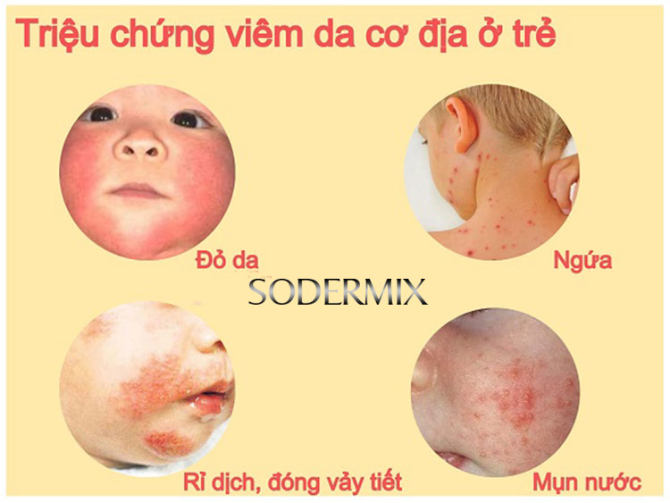 Triệu chứng của bệnh 2