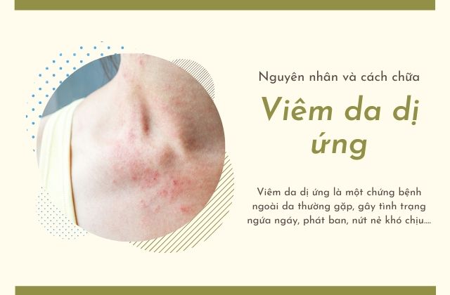 Viêm da dị ứng nguyên nhân và cách trị hiệu quả 1