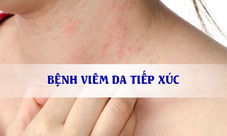 1. Viêm da tiếp xúc là bệnh gì? 1