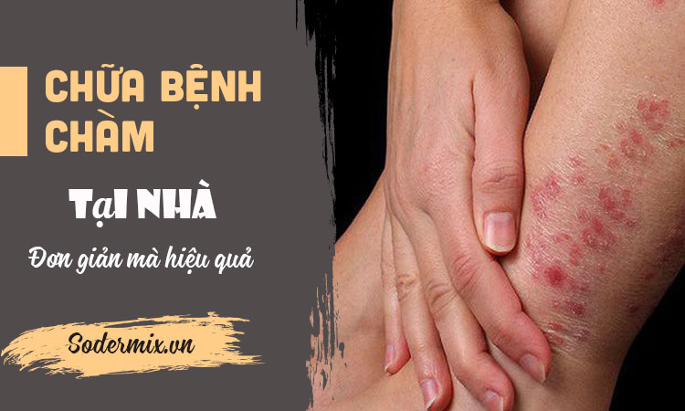 Chữa bệnh chàm eczema tại nhà đơn giản mà hiệu quả