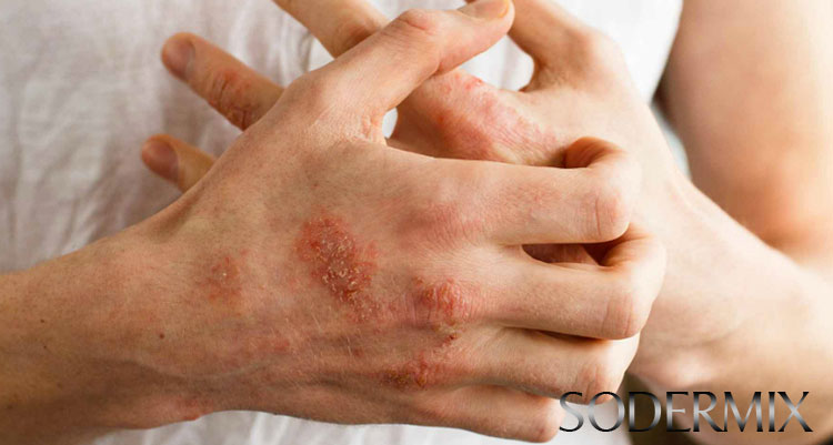 Chàm eczema là gì? 1