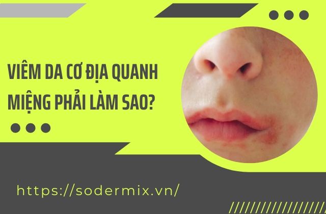 Bị viêm da cơ địa quanh miệng phải làm sao?