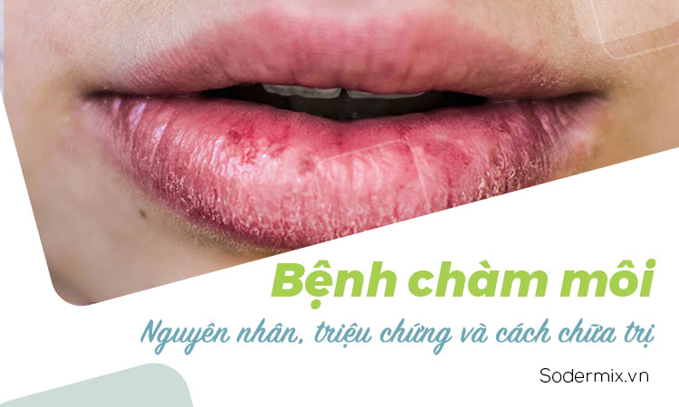 Bệnh chàm môi: Nguyên nhân, triệu chứng và cách chữa trị