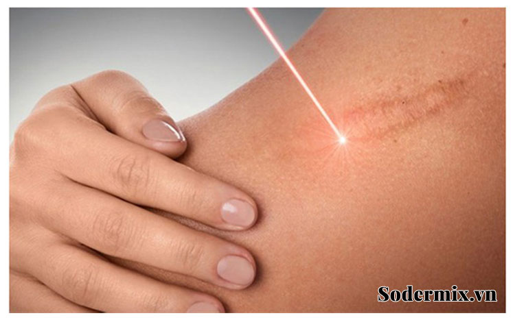 Phương pháp Laser trị sẹo lồi 1