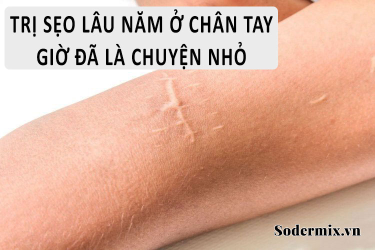 Trị sẹo ở chân tay kể cả lâu năm giờ là chuyện nhỏ!