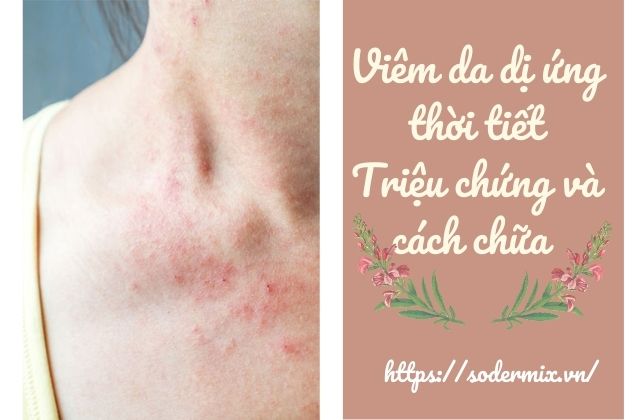 Viêm da dị ứng thời tiết - triệu chứng và cách chữa hiệu quả