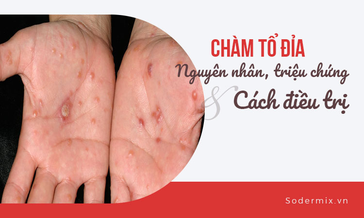 Chàm tổ đỉa: Nguyên nhân, triệu chứng và cách điều trị