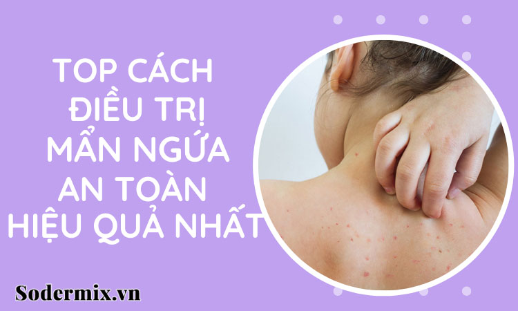 Nắm bắt ngay các cách trị mẩn ngứa hiệu quả, an toàn tại nhà!