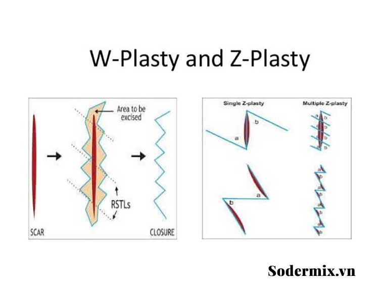 Phẫu thuật cắt W - plasty và cắt Z - plasty 1