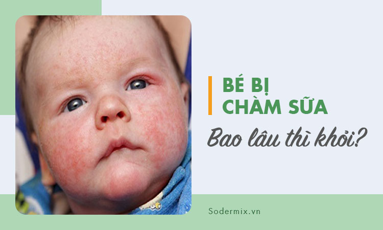 Bé bị chàm sữa, bao lâu thì khỏi?