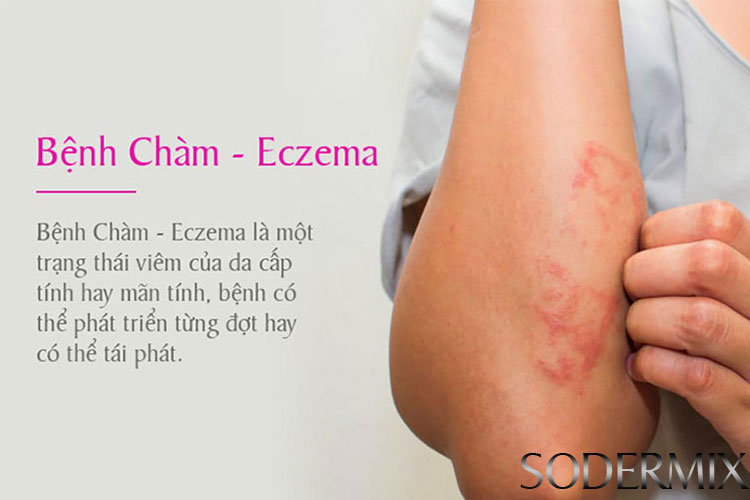 1. Tìm hiểu đôi nét về bệnh eczema 1