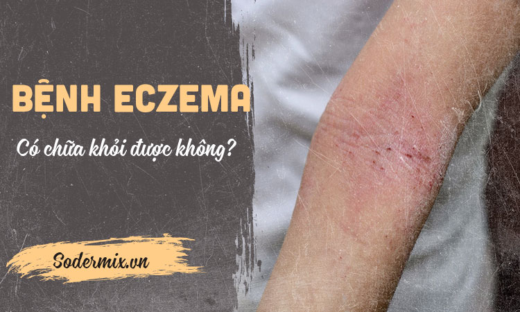 Bệnh eczema có chữa khỏi được không?