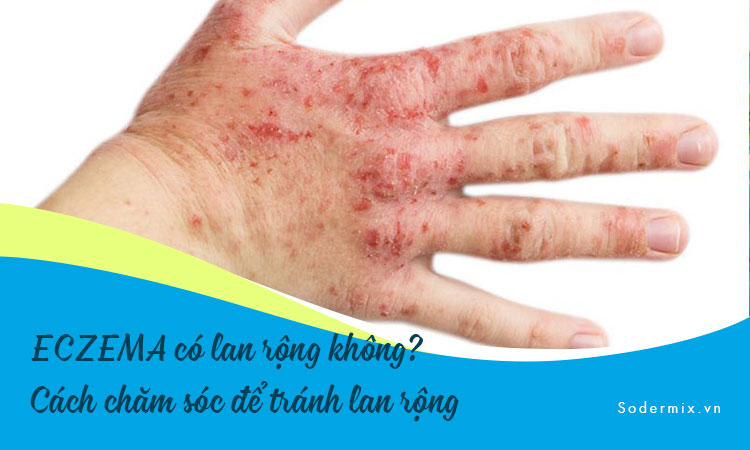 ECZEMA có lan rộng không? Cách chăm sóc để tránh lan rộng