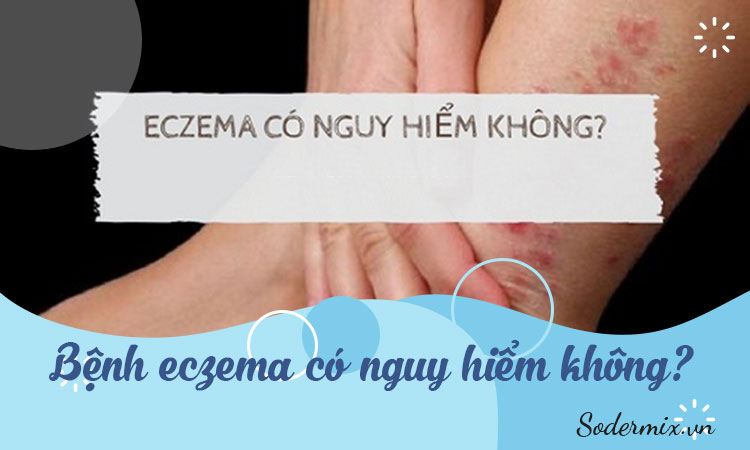 Bệnh Eczema có nguy hiểm không?