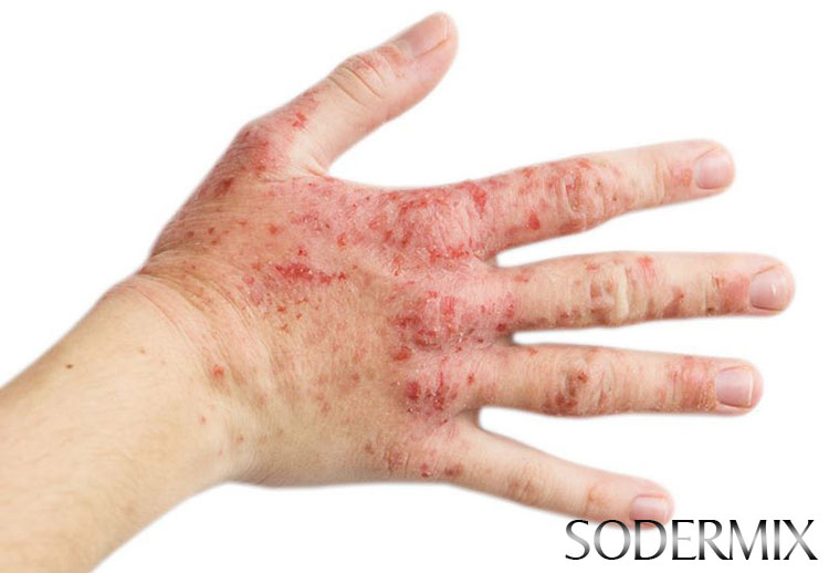 1. Khái quát về Eczema 1