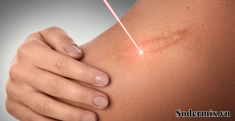 Liệu pháp Laser trị sẹo phì đại 1