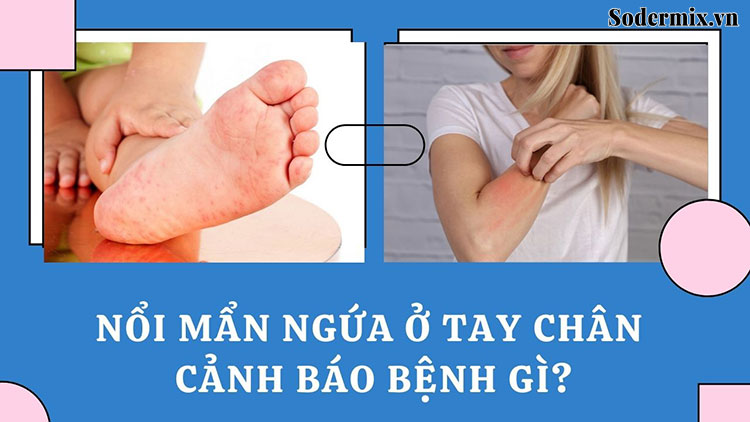Nổi mẩn đỏ ngứa ở tay chân có nguy hiểm? Cách điều trị là gì?