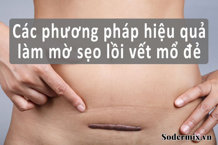 Hé lộ 8 cách xóa làm mờ sẹo lồi vết mổ đẻ hiệu quả