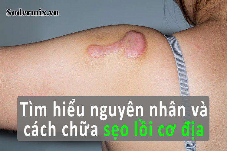 Sẹo lồi cơ địa - nguyên nhân và cách điều trị hiệu quả