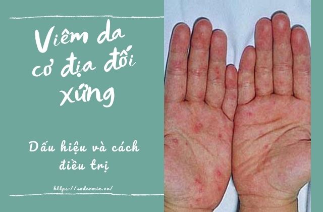 Viêm da cơ địa đối xứng - Dấu hiệu và cách điều trị