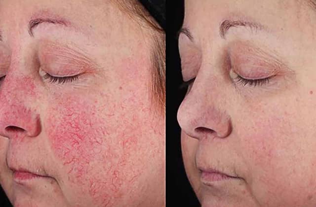 Hội chứng Rosacea 1