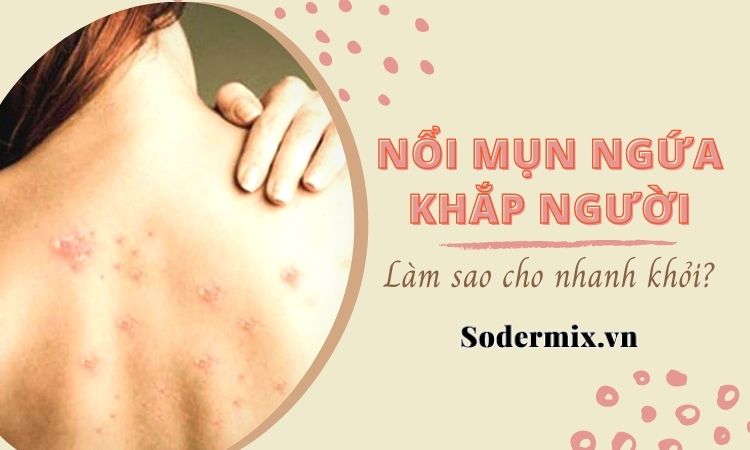 Nổi mụn ngứa khắp người là bệnh gì? Làm sao nhanh khỏi?