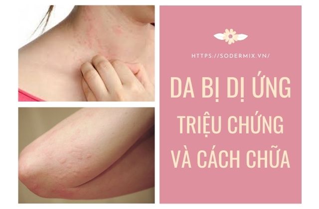 Triệu chứng dị ứng da và cách chữa hiệu quả