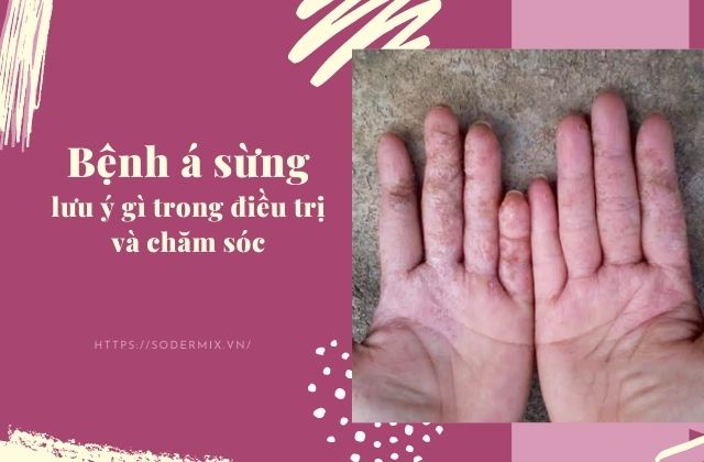 Viêm da cơ địa á sừng cần lưu ý gì trong điều trị và chăm sóc 1